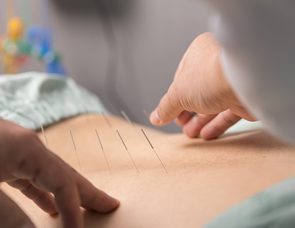 침구치료 이미지