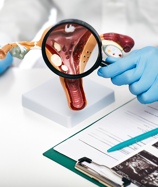 다낭성난소증후군