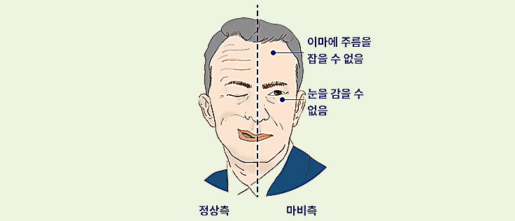 합병증이 없는 감기의 전형적인 증상